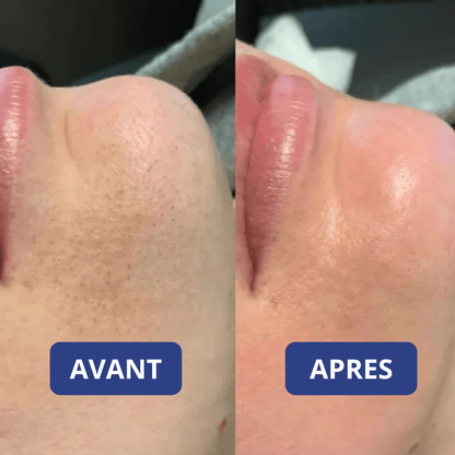 Peel Shot Coréen - Élimine les Impuretés et Sublime Votre Peau