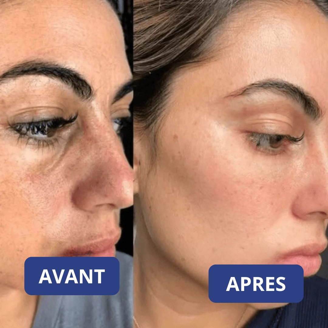 Peel Shot Coréen - Élimine les Impuretés et Sublime Votre Peau