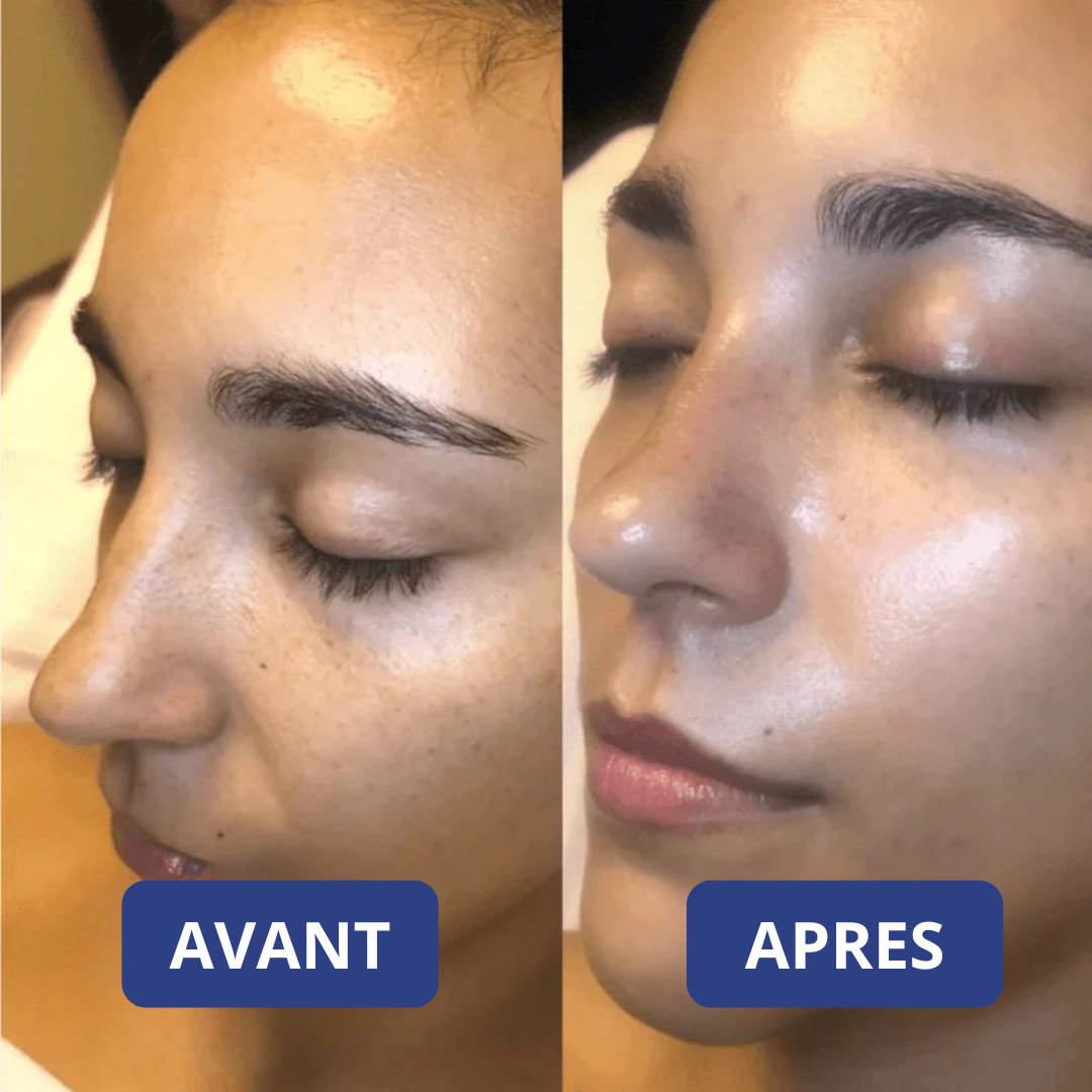 Peel Shot Coréen - Élimine les Impuretés et Sublime Votre Peau