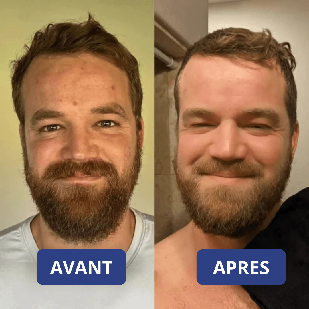 Peel Shot Coréen - Élimine les Impuretés et Sublime Votre Peau